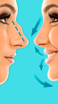 Download Rhinoplasty - Nose Editor Kecantikan untuk Android tangkapan layar 4